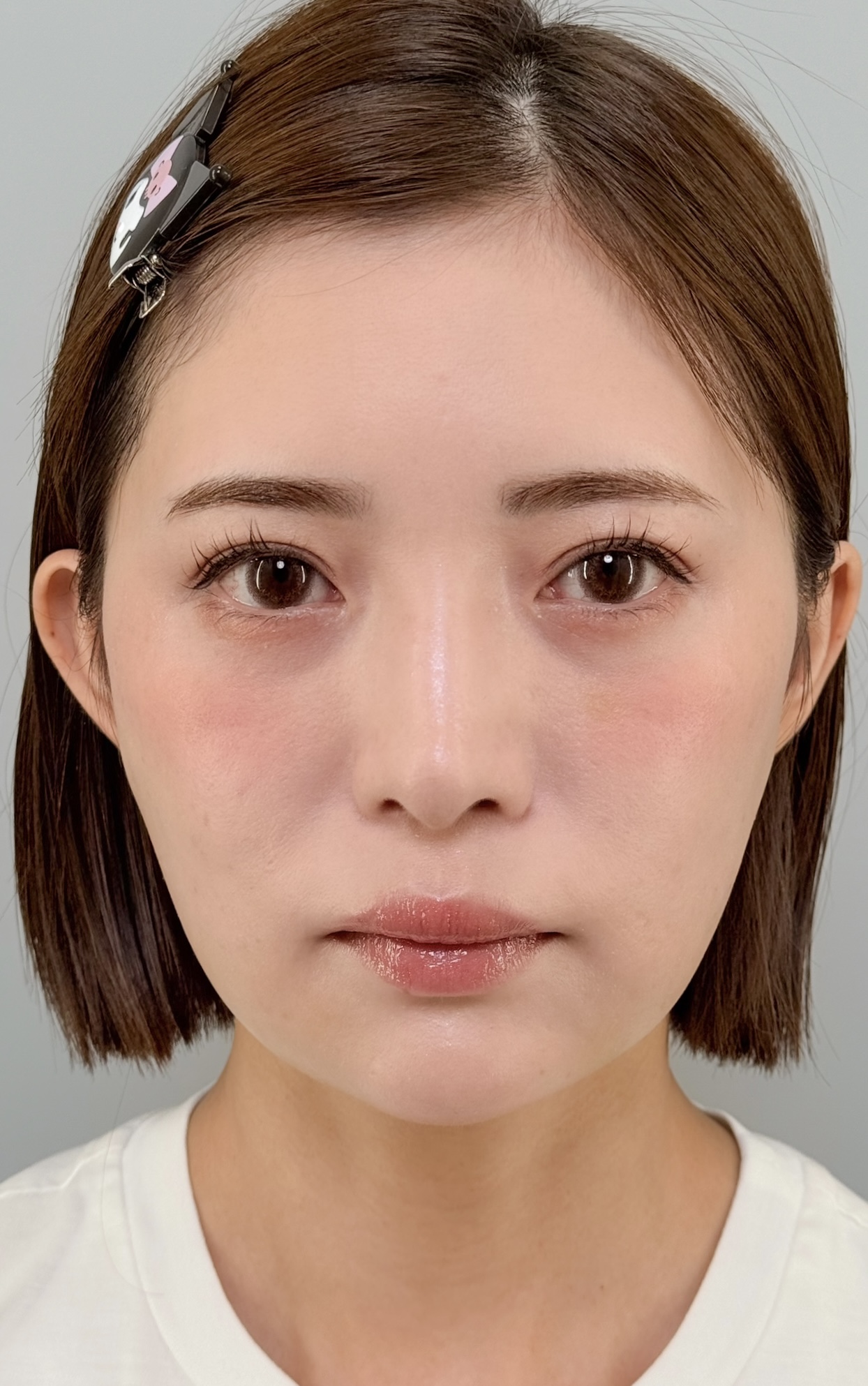 治療後（メイクあり）1