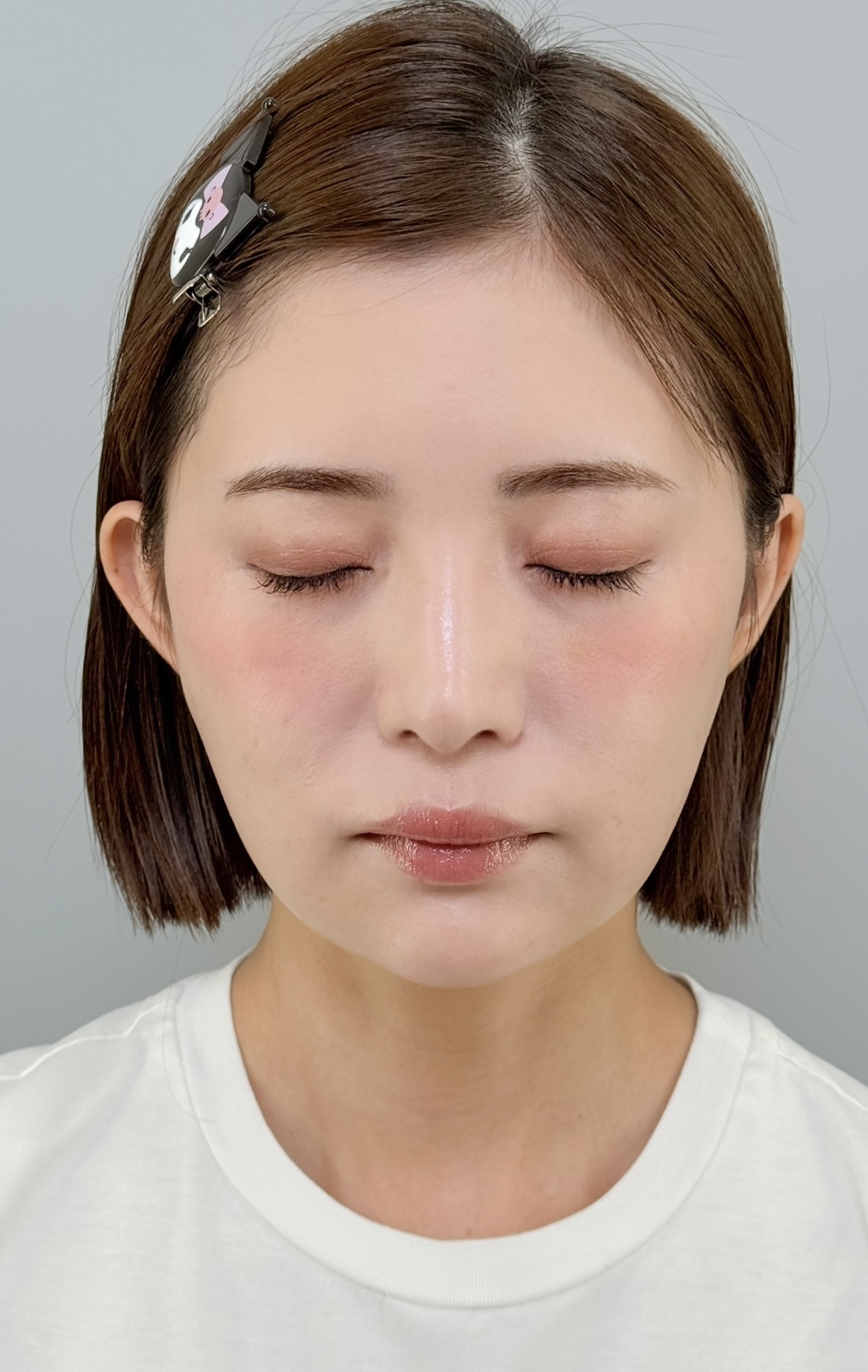 治療後（メイクあり）2