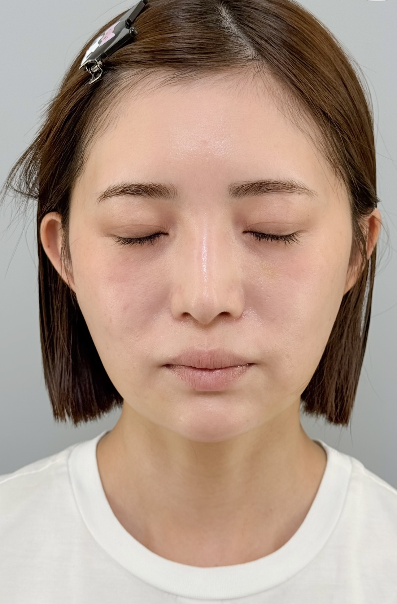 治療後（メイクなし）2