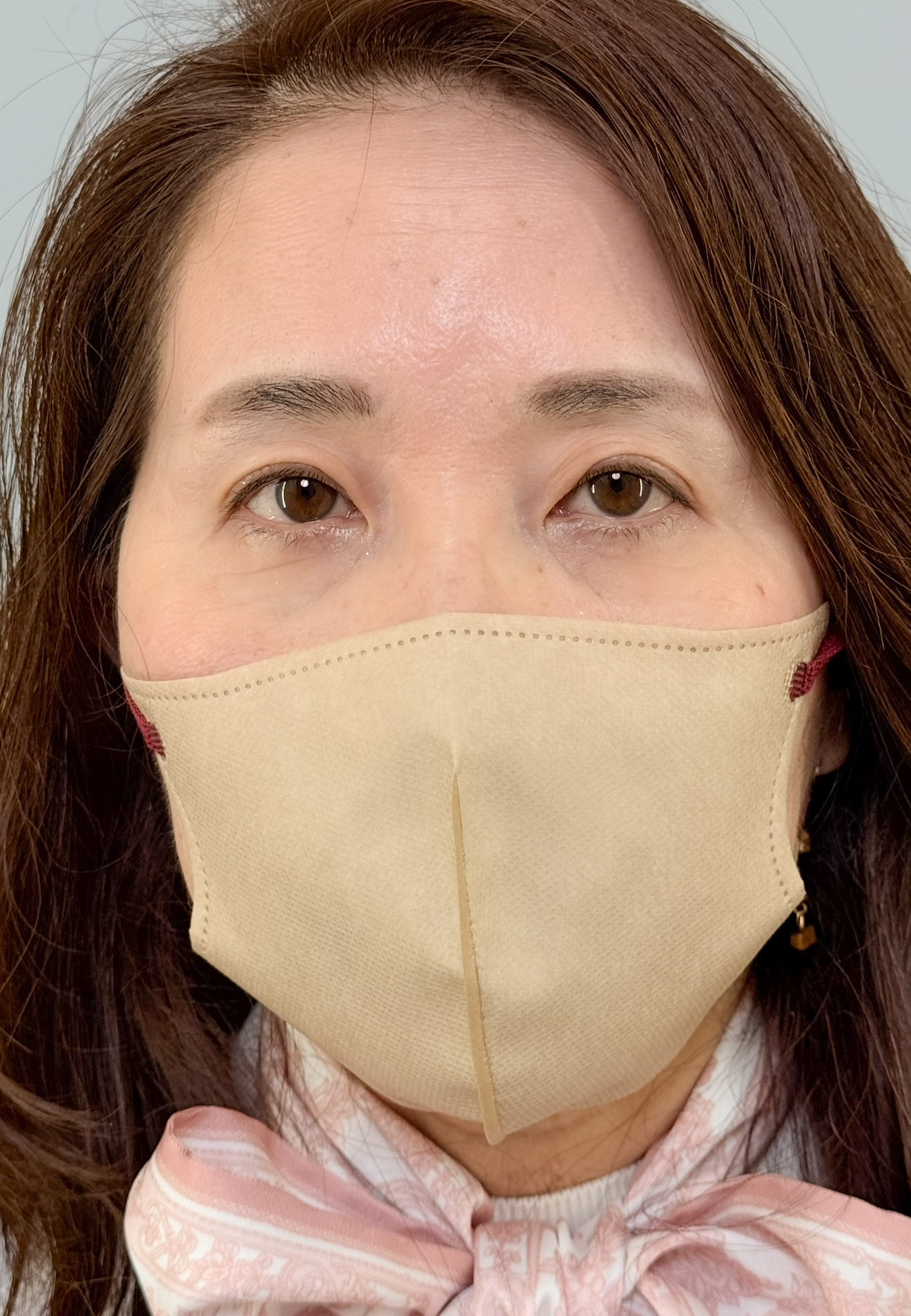 治療後(メイクあり) 1