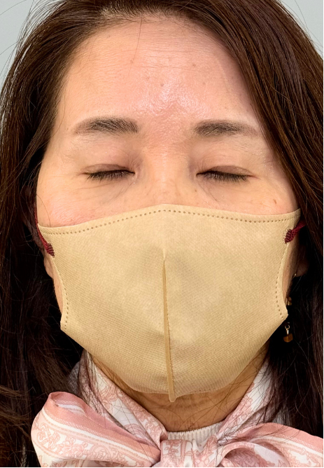 治療後(メイクあり) 2