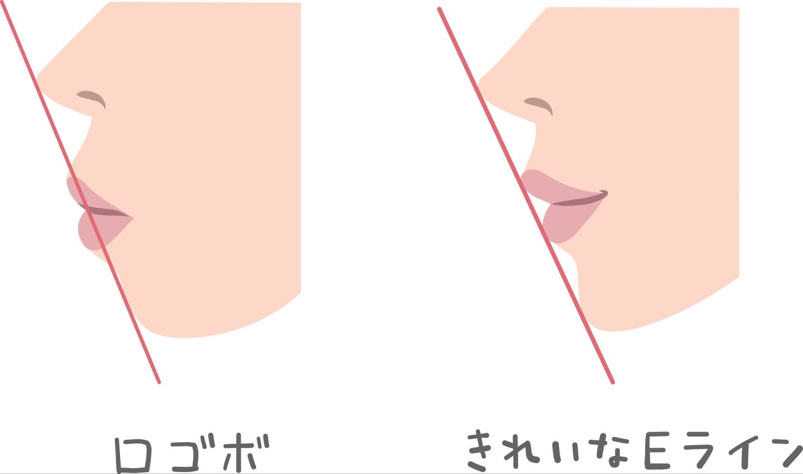 口ゴボときれいなEラインの比較