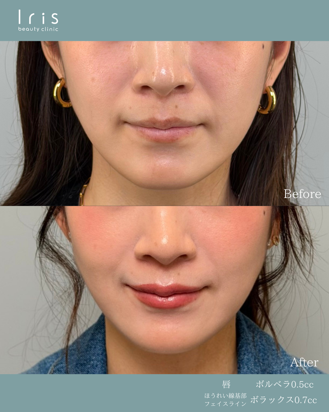 ボルベラ0.5cc(唇)、ボラックス0.7cc(ほうれい線、フェイスライン)