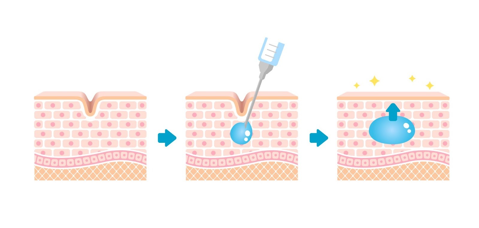 ヒアルロン酸注射