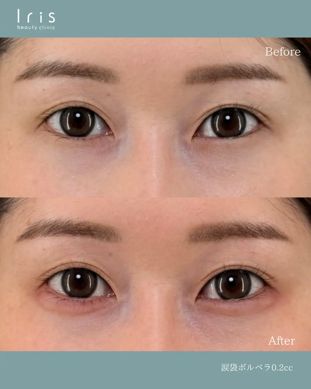 涙袋ヒアルロン酸注射（ボルベラ0.2cc）