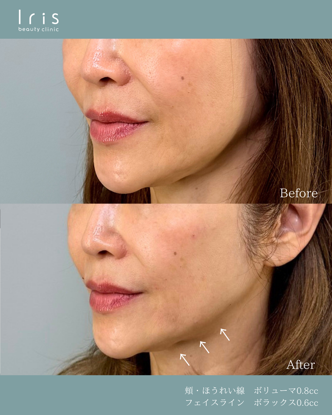 ヒアルロン酸注射の症例写真（ボラックス0.6cc(フェイスライン)、ボリューマ0.8cc(頬・ほうれい線)）