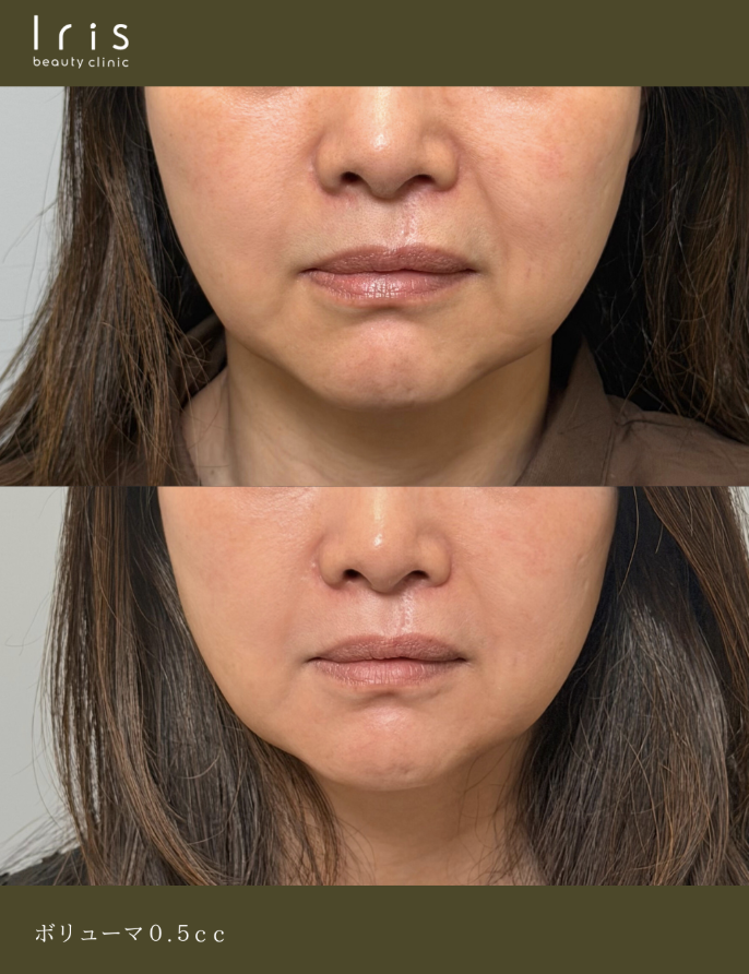 ヒアルロン酸の症例写真（施術内容：ボリューマ0.5cc(ほうれい線基部)、0.5cc(リフトアップ)1ヶ月後）