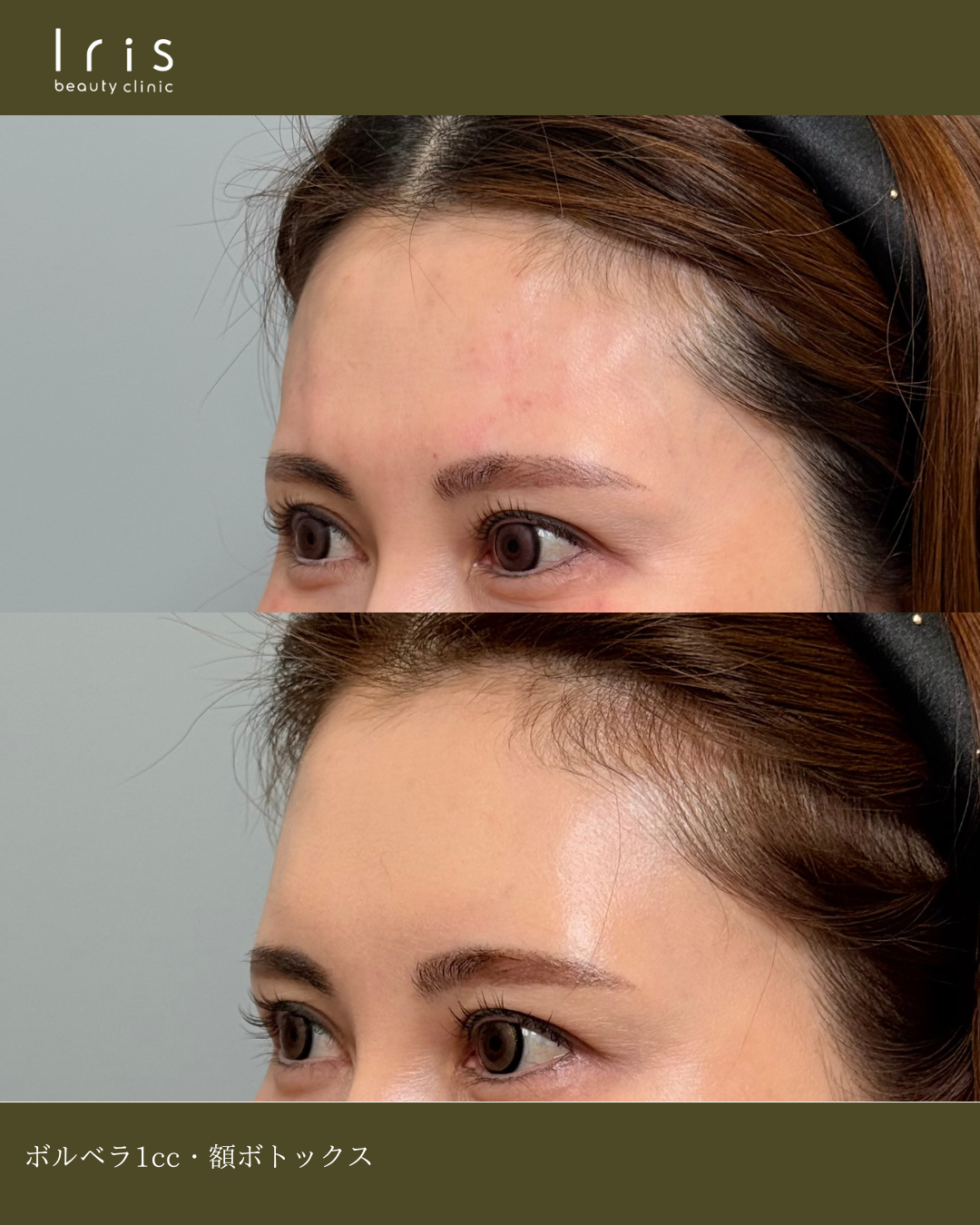 ボルベラ1cc、額ボトックス(アラガン)