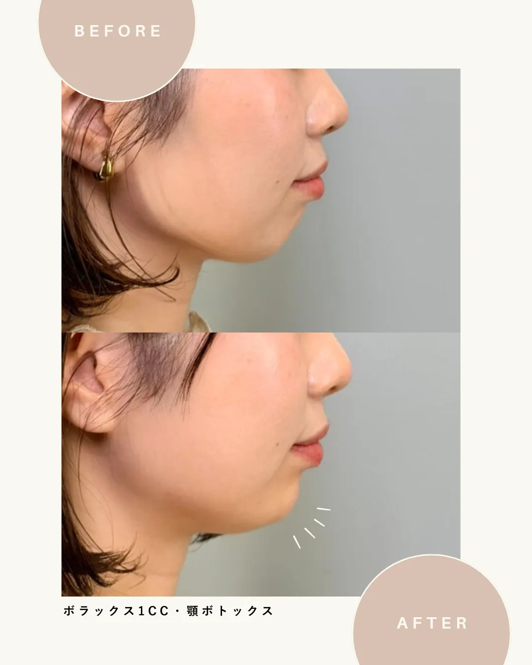 ボラックス1cc・顎ボトックス(アラガン)
