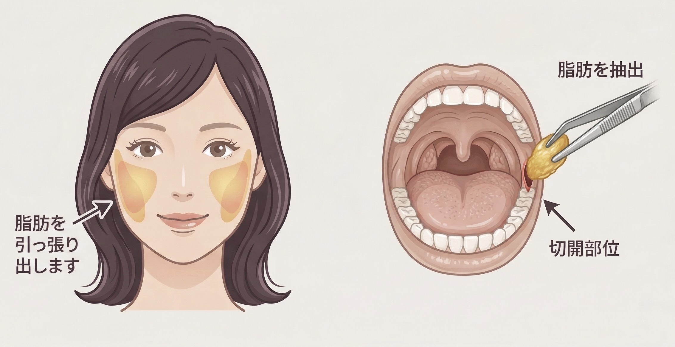 バッカルファット