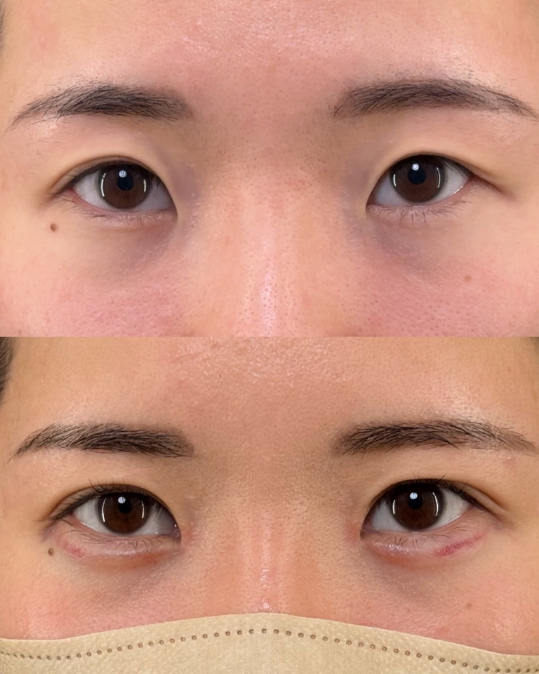 目頭切開と二重埋没法の症例写真（上：術前／下：術後1ヶ月・メイクなし）