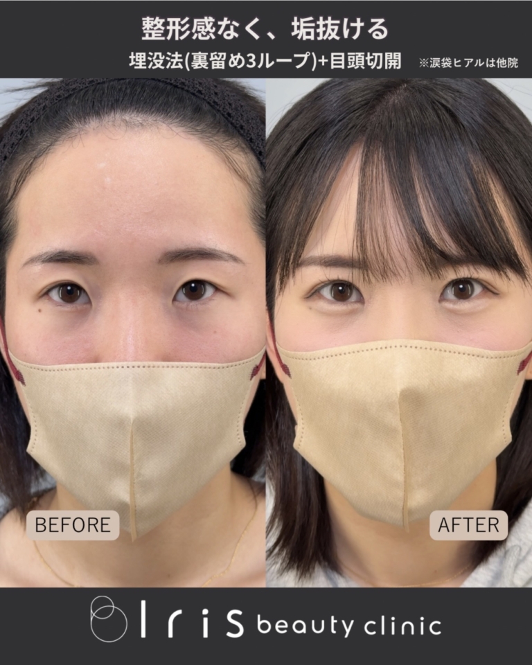 目頭切開と二重埋没法の症例写真（左：術前／右：術後1ヶ月・メイクあり）