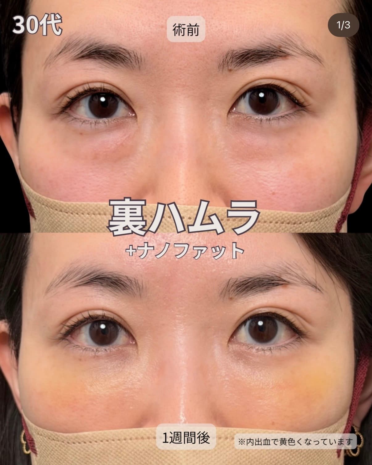 裏ハムラ＋ナノファットの症例（30代 女性）