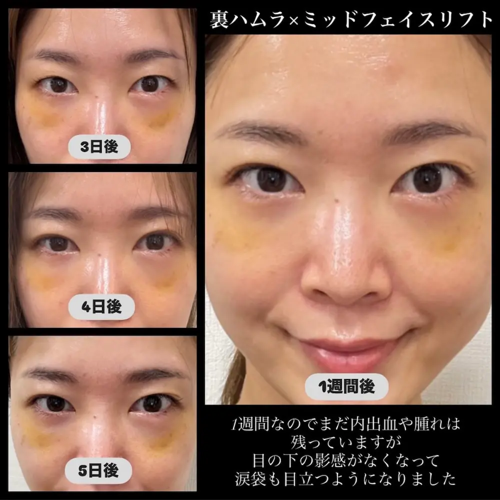 裏ハムラ+ミッドフェイスリフトのダウンタイム