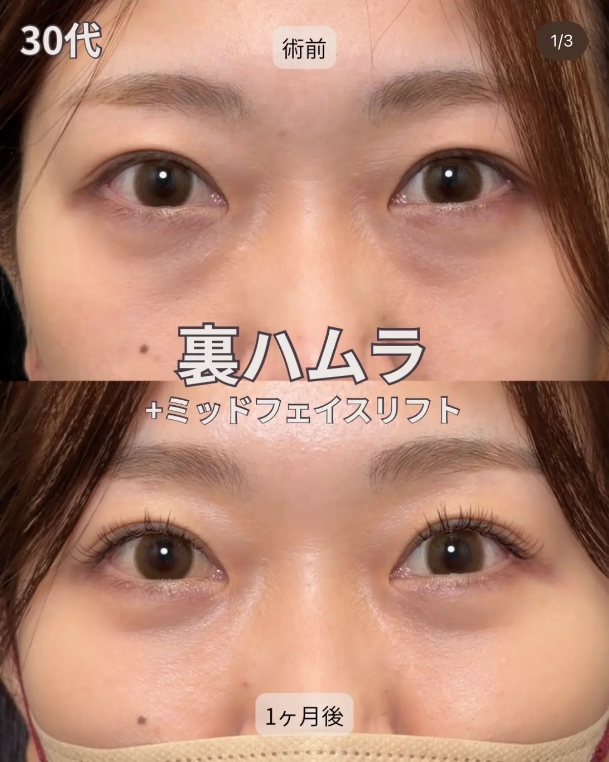 裏ハムラ＋ミッドフェイスリフトの症例（30代 女性）
