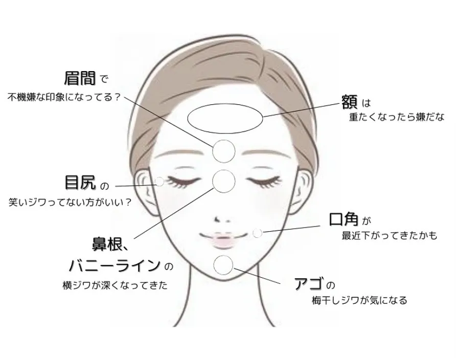 シワ取りボトックスの対象部位
