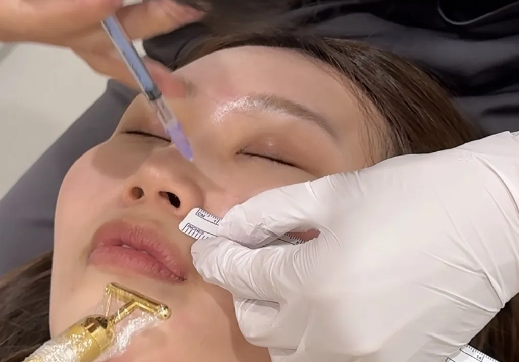 ボトックス注射