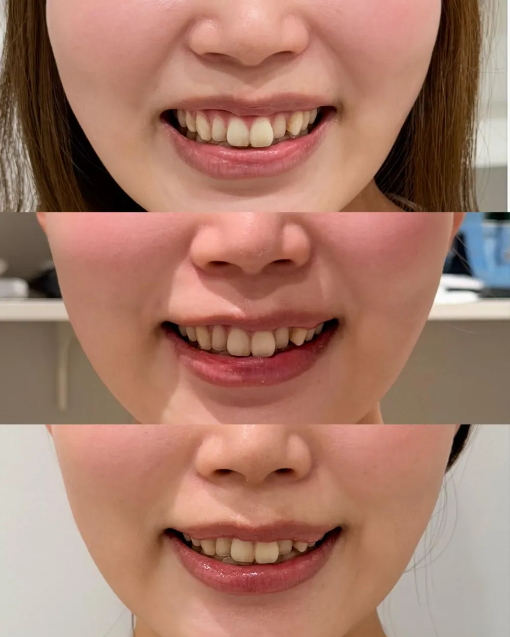 口角ボトックス、ガミーボトックス
（処置前→1週間後（(この時に人中短縮ボトックスも追加）→10日後）