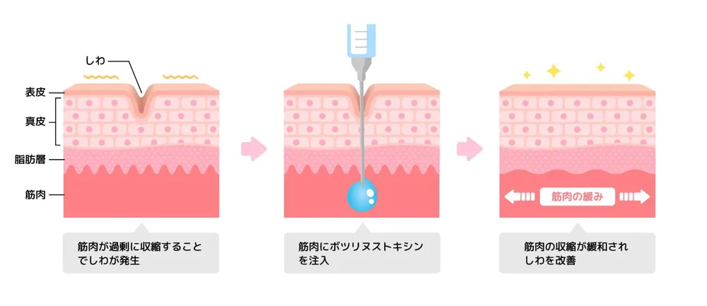 ボトックス注射の仕組み