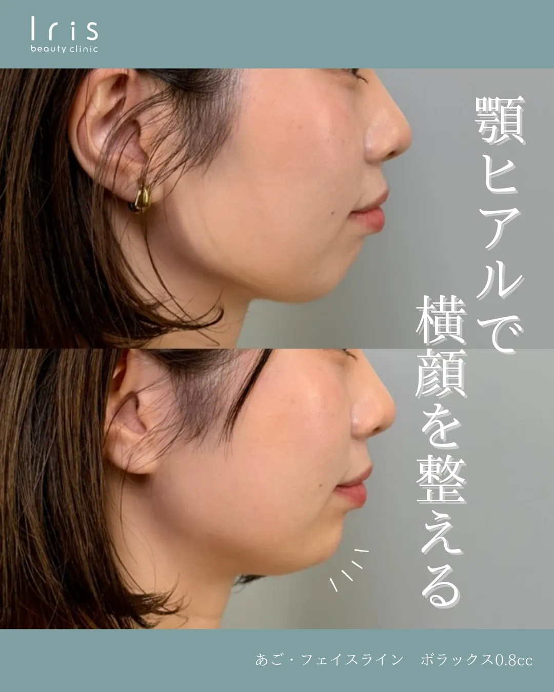 顎ヒアルロン酸（ジュビダーム　ボラックス）、顎ボトックス（ボトックスビスタ）の症例