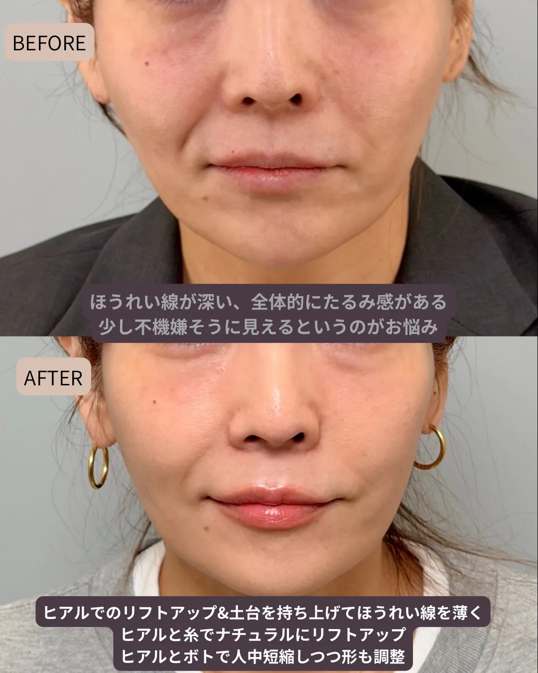 唇ヒアルロン酸（ボルベラ）リフトアップヒアルロン酸（ボリューマ）、ほうれい線基部ヒアルロン酸（ボラックス）、ボトックス（口角、顎、人中短縮）
（施術前→1ヶ月後）
治療回数：1回
