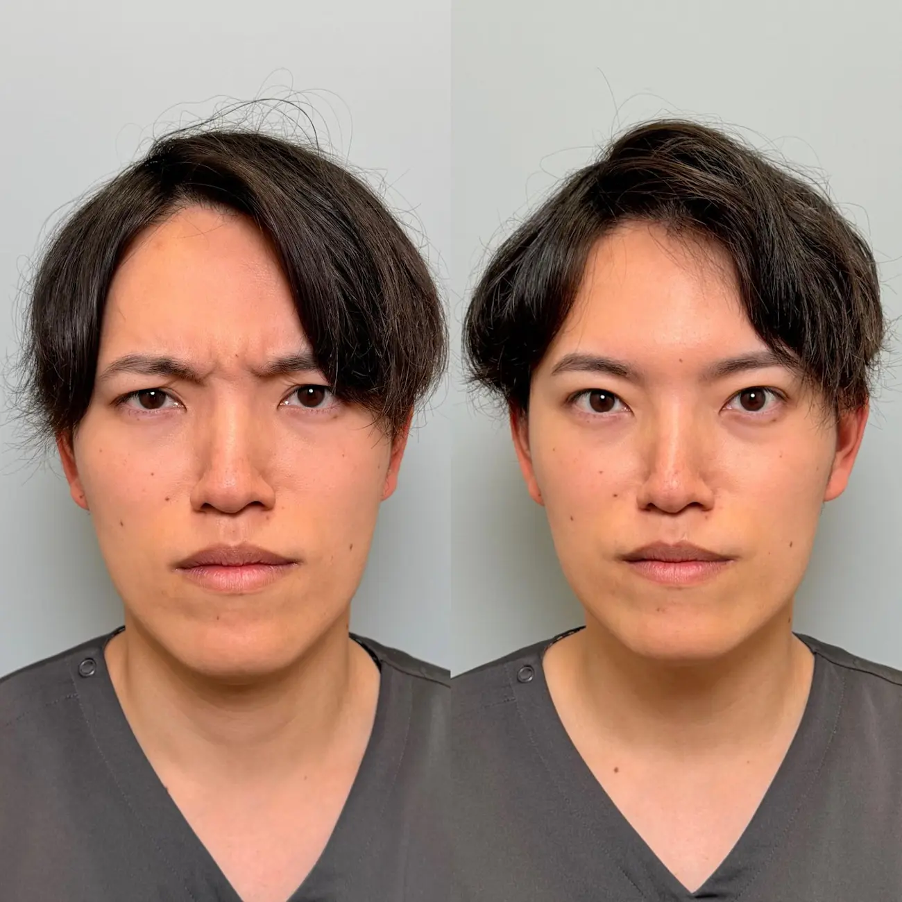 眉間ボトックス