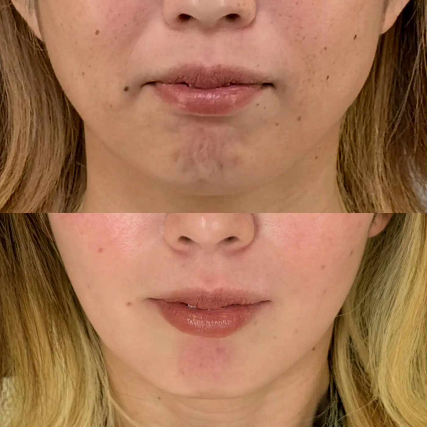 エラボトックスの症例写真