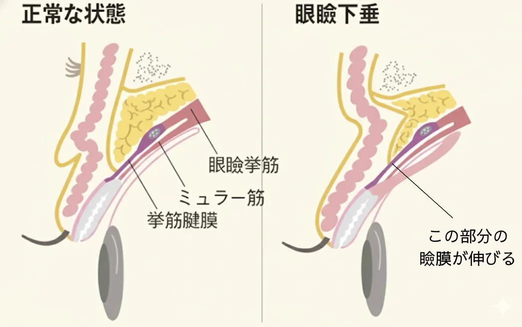 正常な目と眼瞼下垂の状態