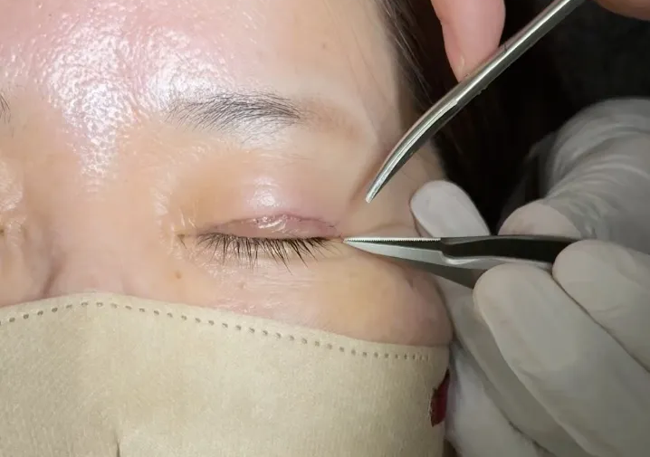 眼瞼下垂手術後の抜糸