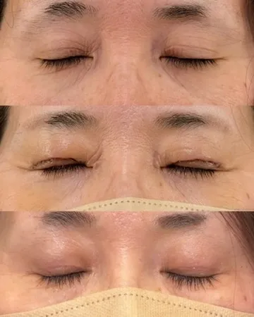 眼瞼下垂のダウンタイム経過