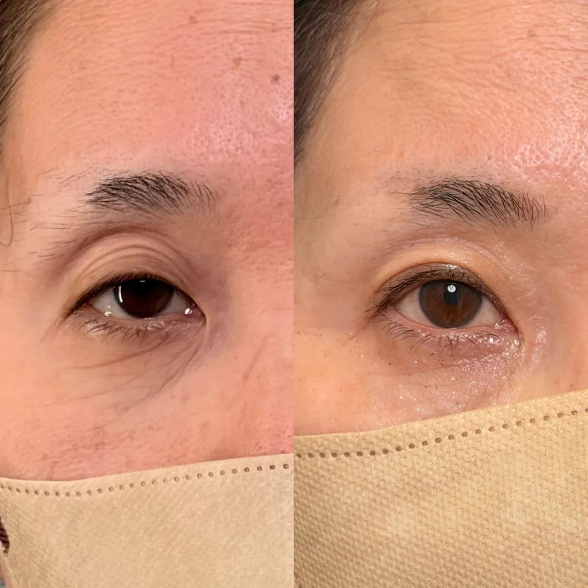 眼瞼下垂手術の症例写真