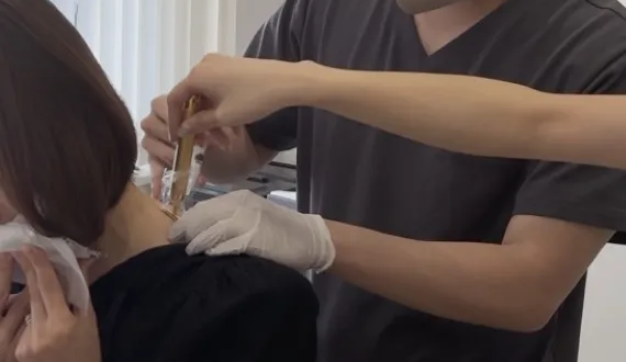 肩ボトックスの様子