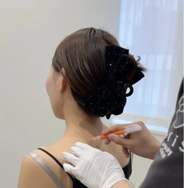 肩ボトックスの様子