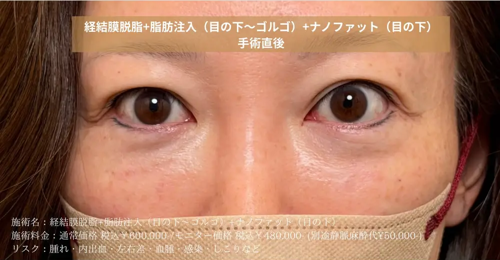 経結膜脱脂術＋脂肪注入のダウンタイムと術後の経過