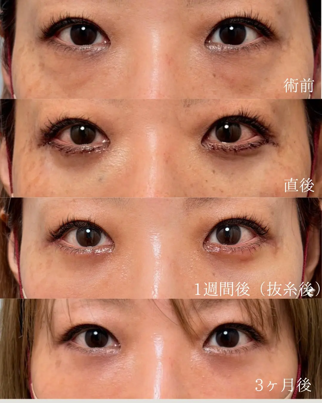 切開ハムラ法・目の下の皮膚切除の経過写真