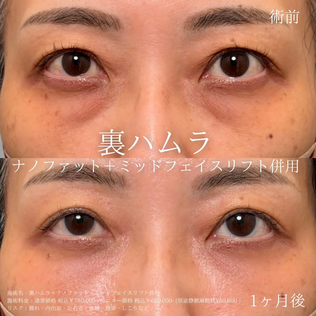 裏ハムラ（ナノファット＋ミッドフェイスリフト併用）の症例 女性 術前・術後1ヶ月