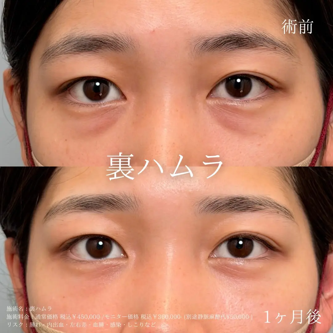 裏ハムラの症例 男性 術前・術後1ヶ月