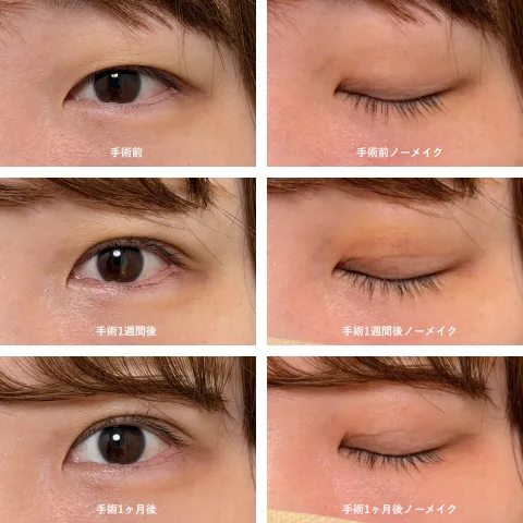 二重埋没法（アイリスループトリプル）のダウンタイム 手術前・術後1週間・術後1ヶ月