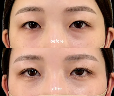 アイリスループダブル（二重埋没）【20代】術後1ヶ月後