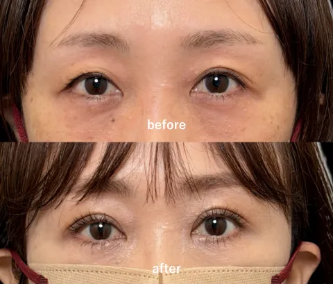 アイリスループトリプル（二重埋没）【40代】術後1ヶ月後