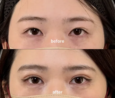 アイリスループトリプル（二重埋没）【20代】術後1ヶ月後