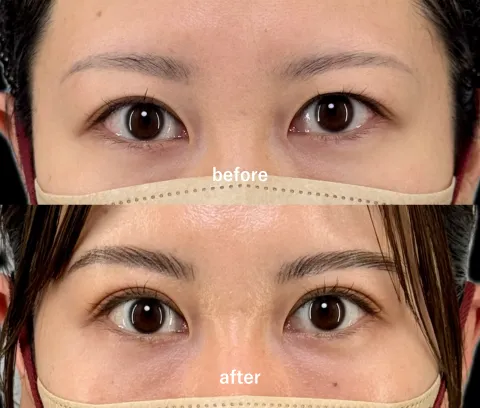 アイリスループダブル（二重埋没）【30代】術後1ヶ月後