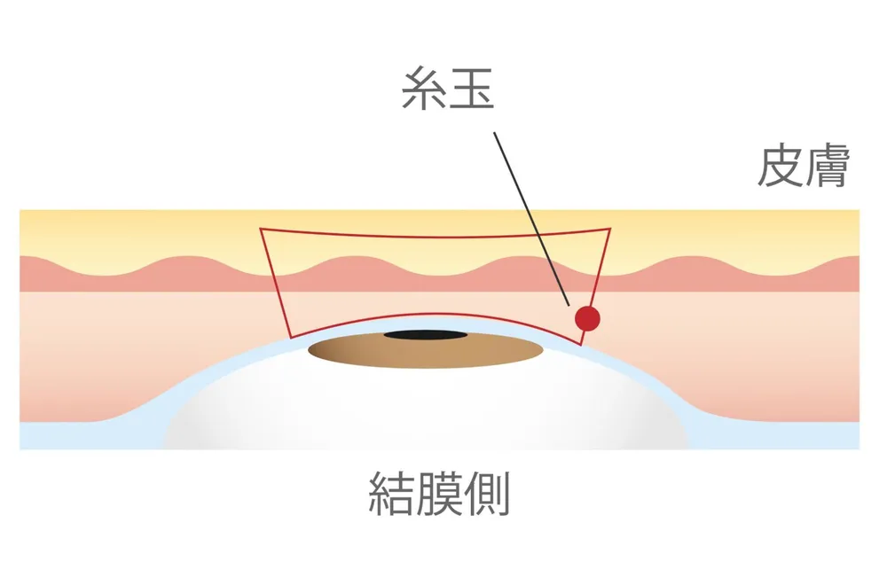 二重埋没法とは