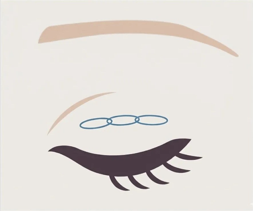 アイリスループトリプル（一生涯保証・最高強度）