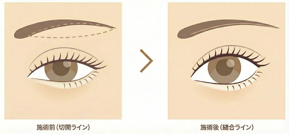 眉下切開（眉下リフト）