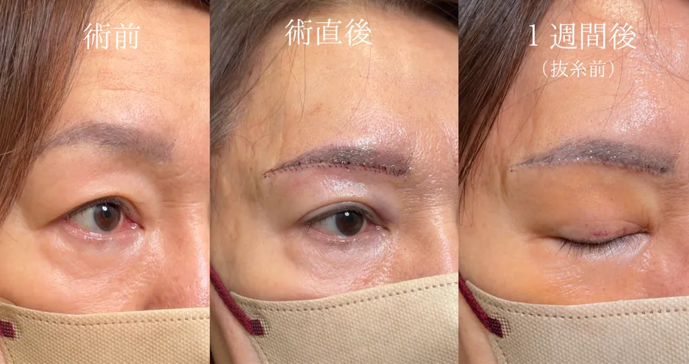 眉下切開＋眼窩脂肪移動術の症例（1週間後）