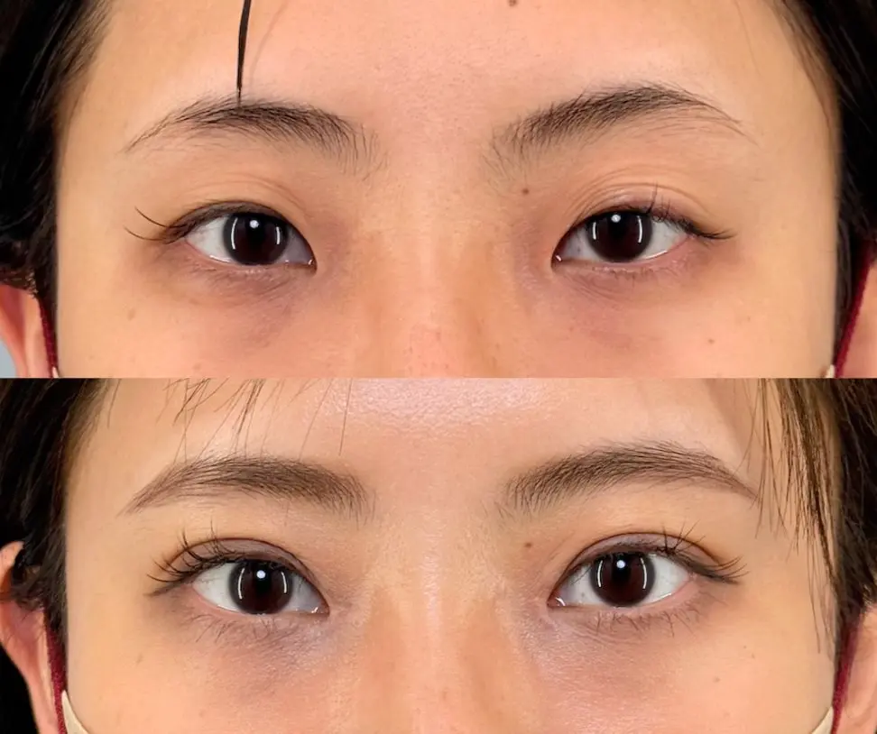 目頭切開＋埋没法（アイリスループトリプル）術前・術後1ヶ月