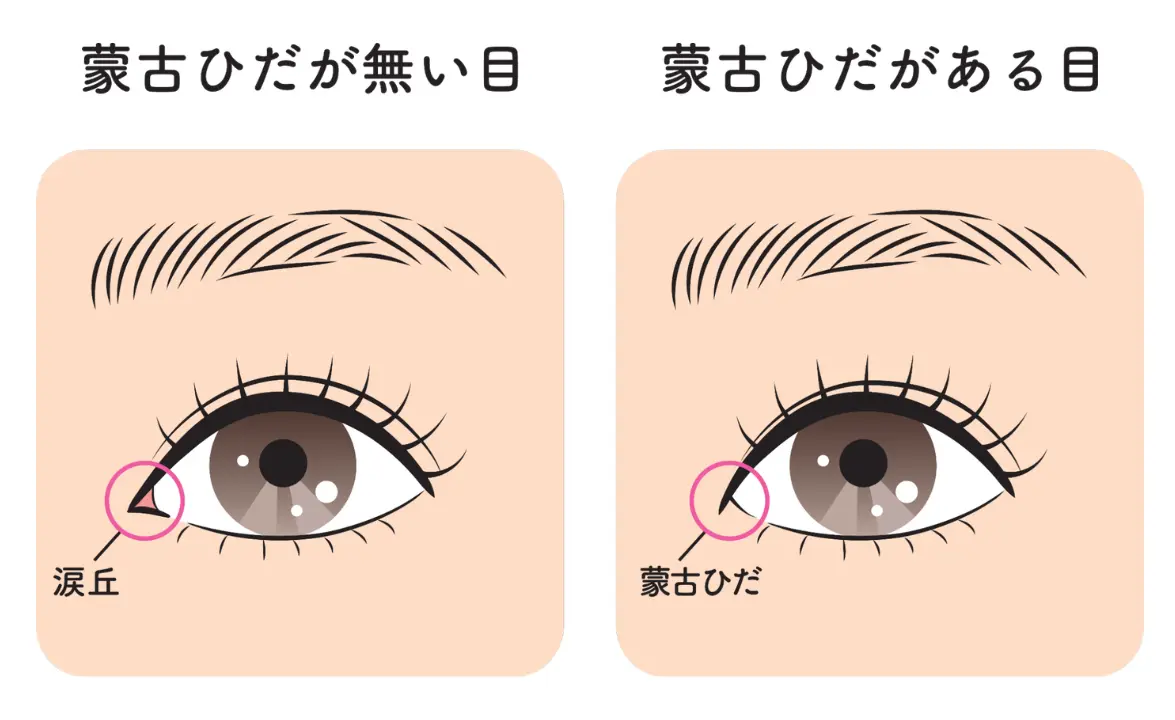 目頭切開の図解
