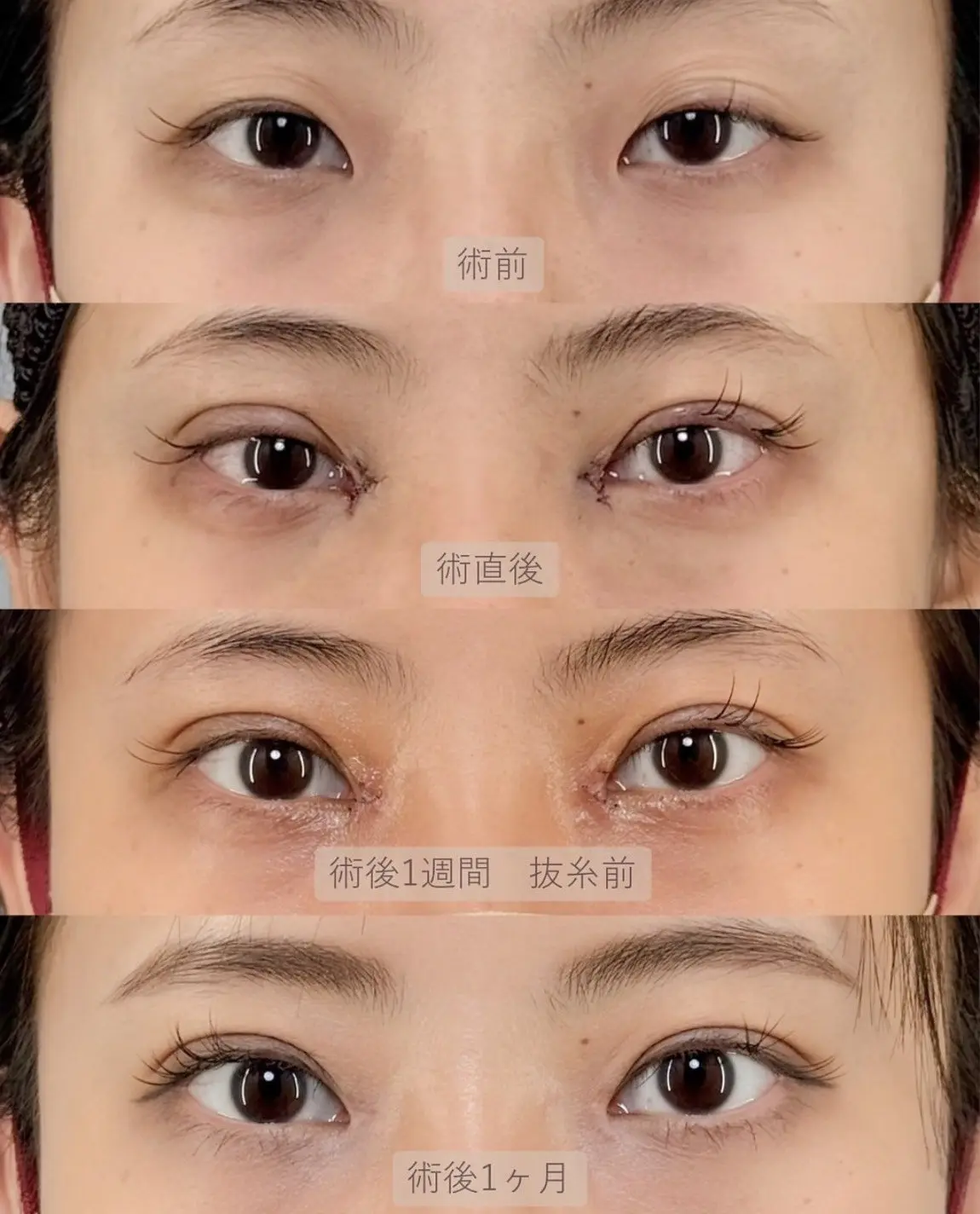 目頭切開のダウンタイム（術前・術直後・術後1週間 抜糸前・術後1ヶ月）