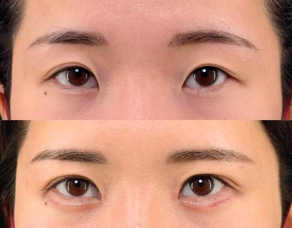 目頭切開＋埋没法（アイリスループトリプル）術前・術後1ヶ月